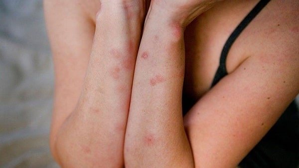 What Bedbug Bites Look Like — and How to Stop the Itch