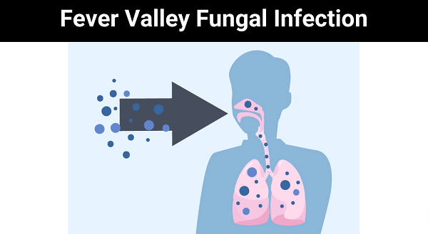 Fever Valley Fungal Infection {2023}: Read About Valley Fungal?