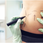 Embracing Your New Body: What to Expect When Recovering From a Tummy Tuck