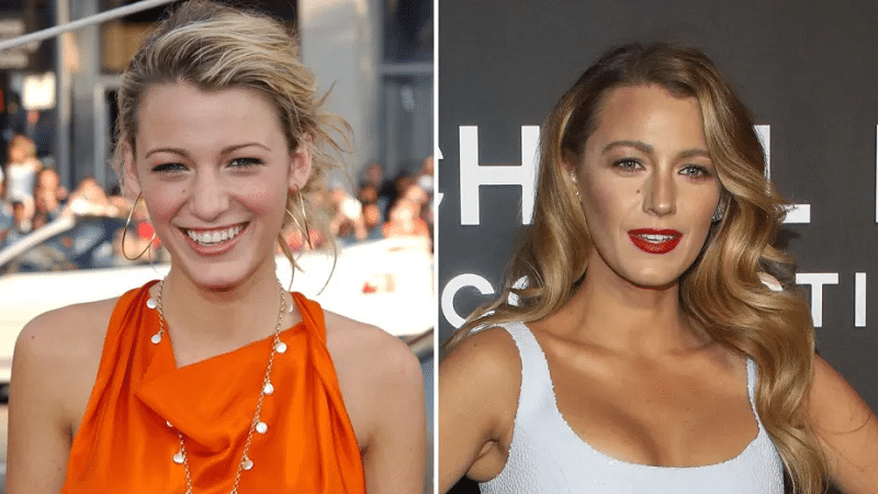 Did Blake Lively Get Plastic Surgery